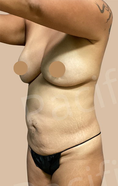Procedure before and after - before