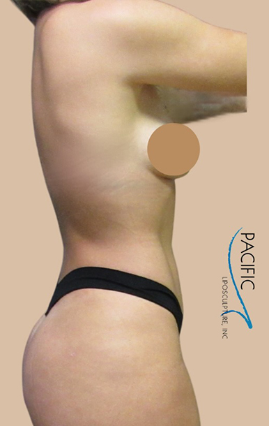 Procedure before and after - after