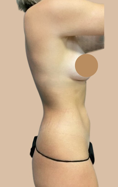 Procedure before and after - before