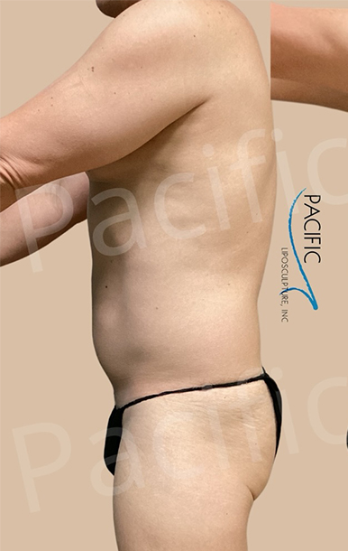 Procedure before and after - before
