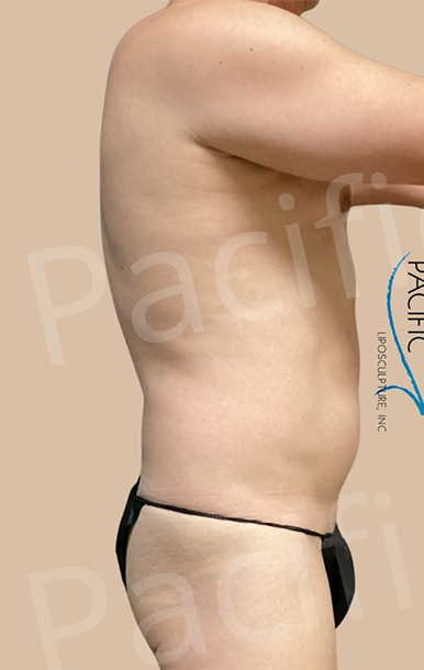 Procedure before and after - before