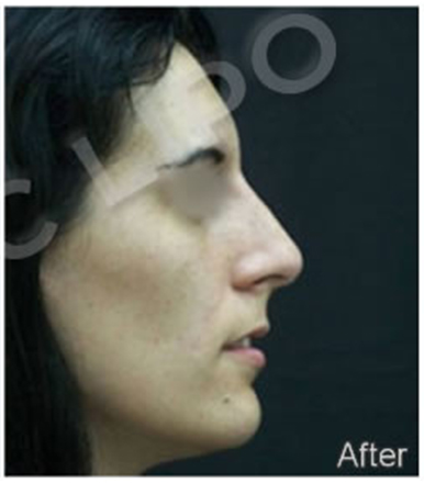 Procedure before and after - after