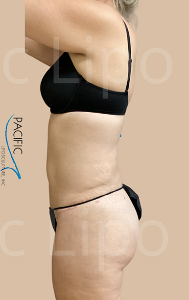 Procedure before and after - after