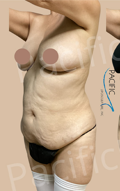 Procedure before and after - before
