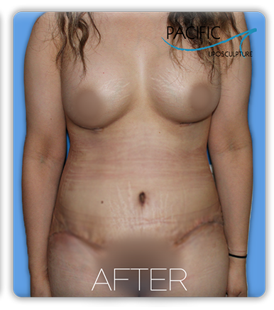 Procedure before and after - after