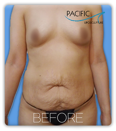 Procedure before and after - before