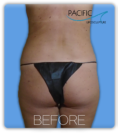Procedure before and after - before