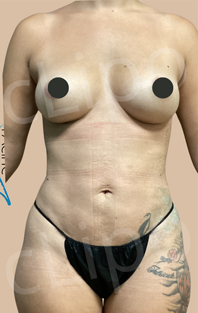 Procedure before and after - after