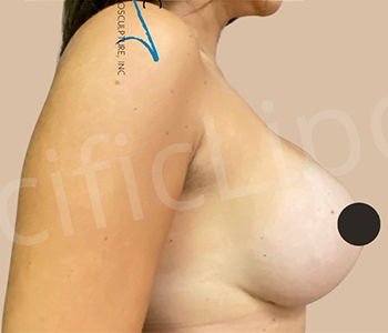 Procedure before and after - after