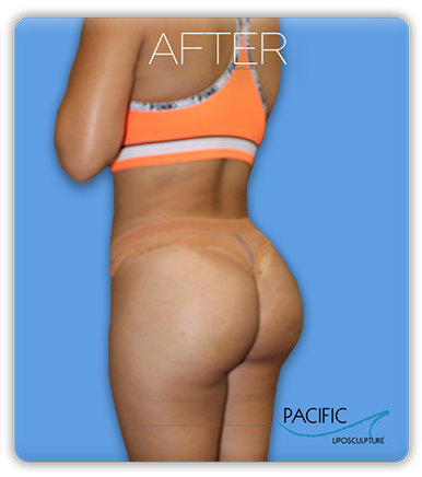 Procedure before and after - after