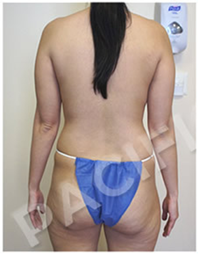 Procedure before and after - before
