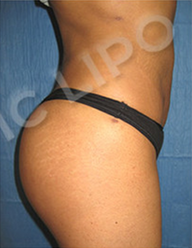 Procedure before and after - after