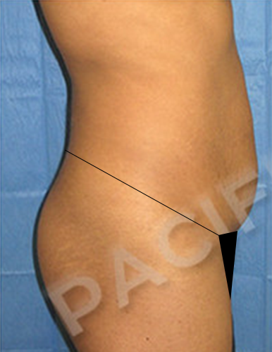 Procedure before and after - before