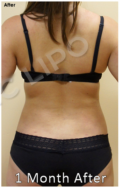 Procedure before and after - before