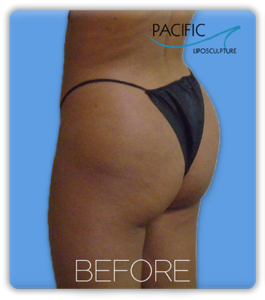 Procedure before and after - before