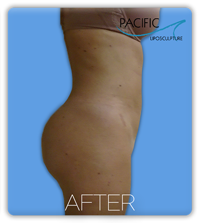 Procedure before and after - after