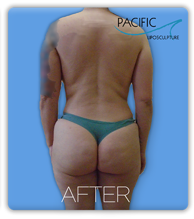 Procedure before and after - after