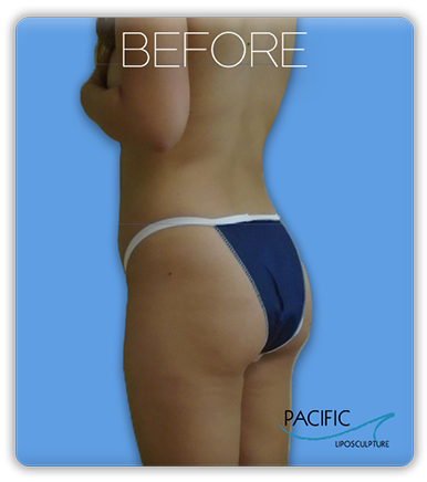 Procedure before and after - before