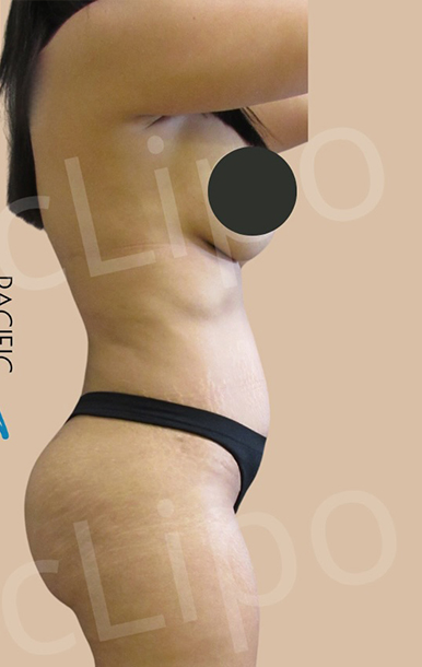 Procedure before and after - after