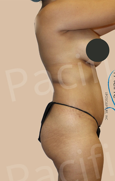 Procedure before and after - before