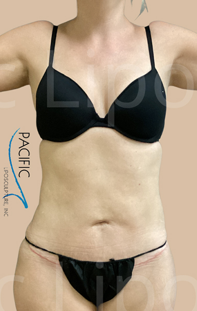 Procedure before and after - after
