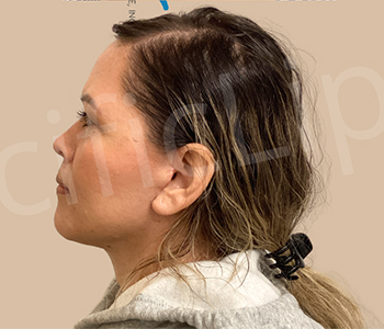 Procedure before and after - after