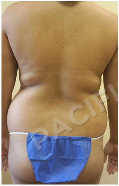 Procedure before and after - before