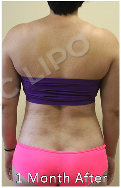 Procedure before and after - before