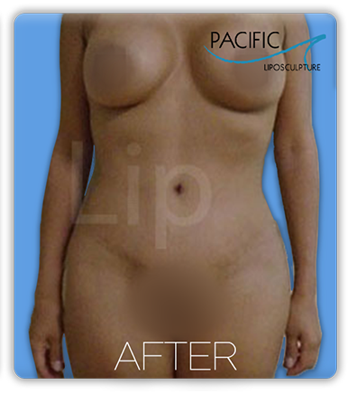 Procedure before and after - after