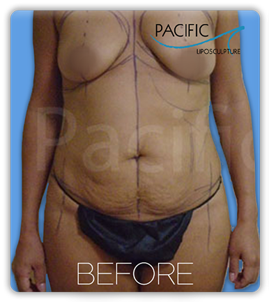 Procedure before and after - before