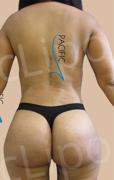 Procedure before and after - after