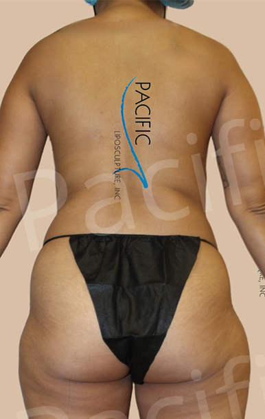 Procedure before and after - before