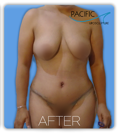 Procedure before and after - after