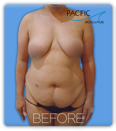 Procedure before and after - before
