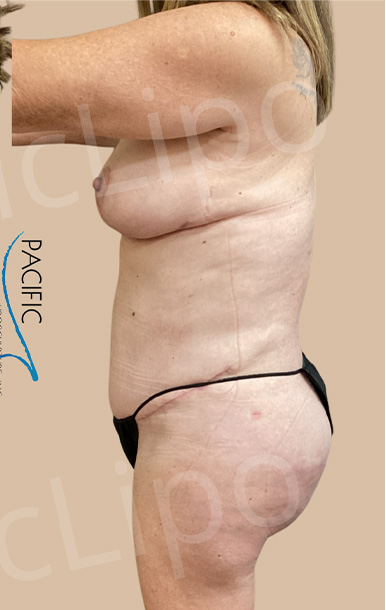 Procedure before and after - after
