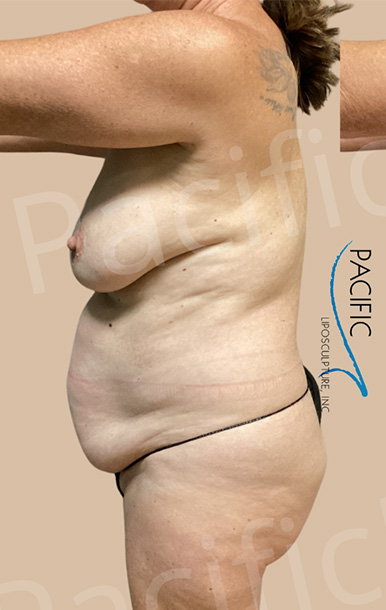 Procedure before and after - before