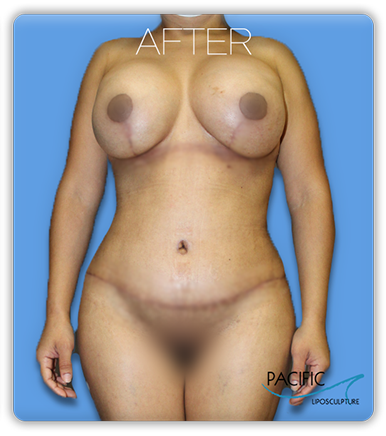 Procedure before and after - after