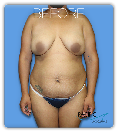 Procedure before and after - before