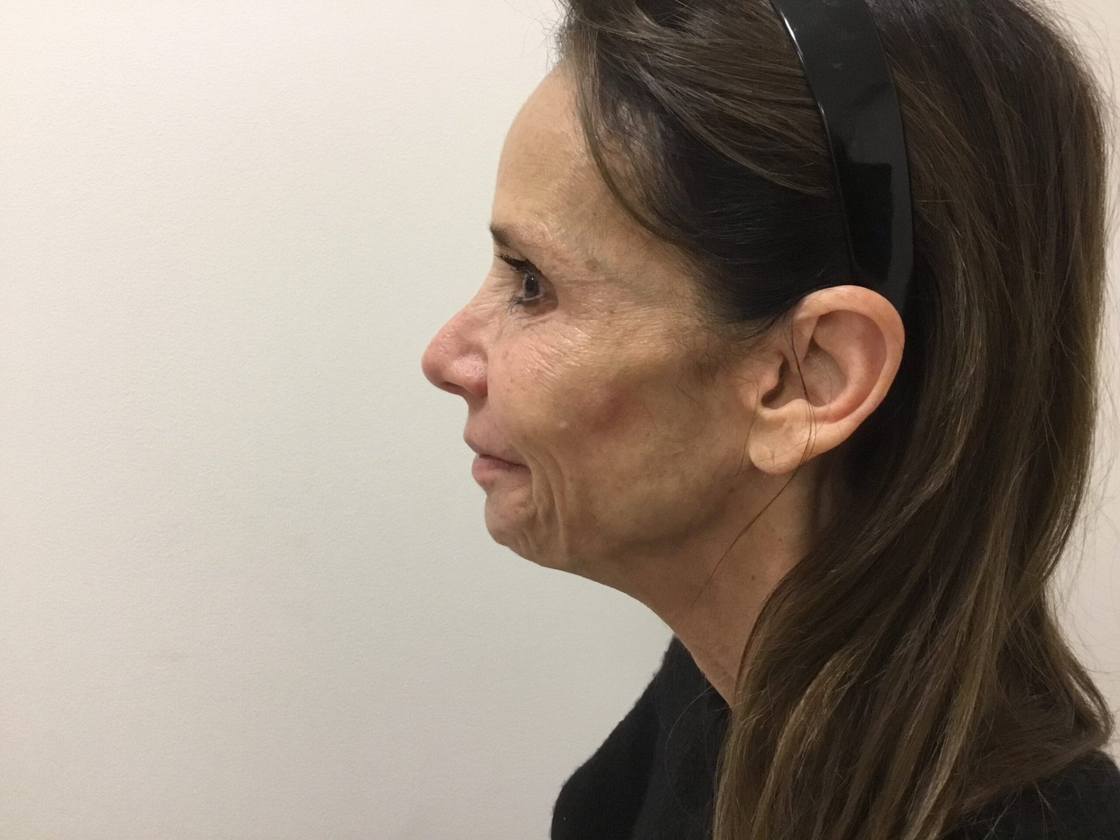 Cheek Filler before and after - after