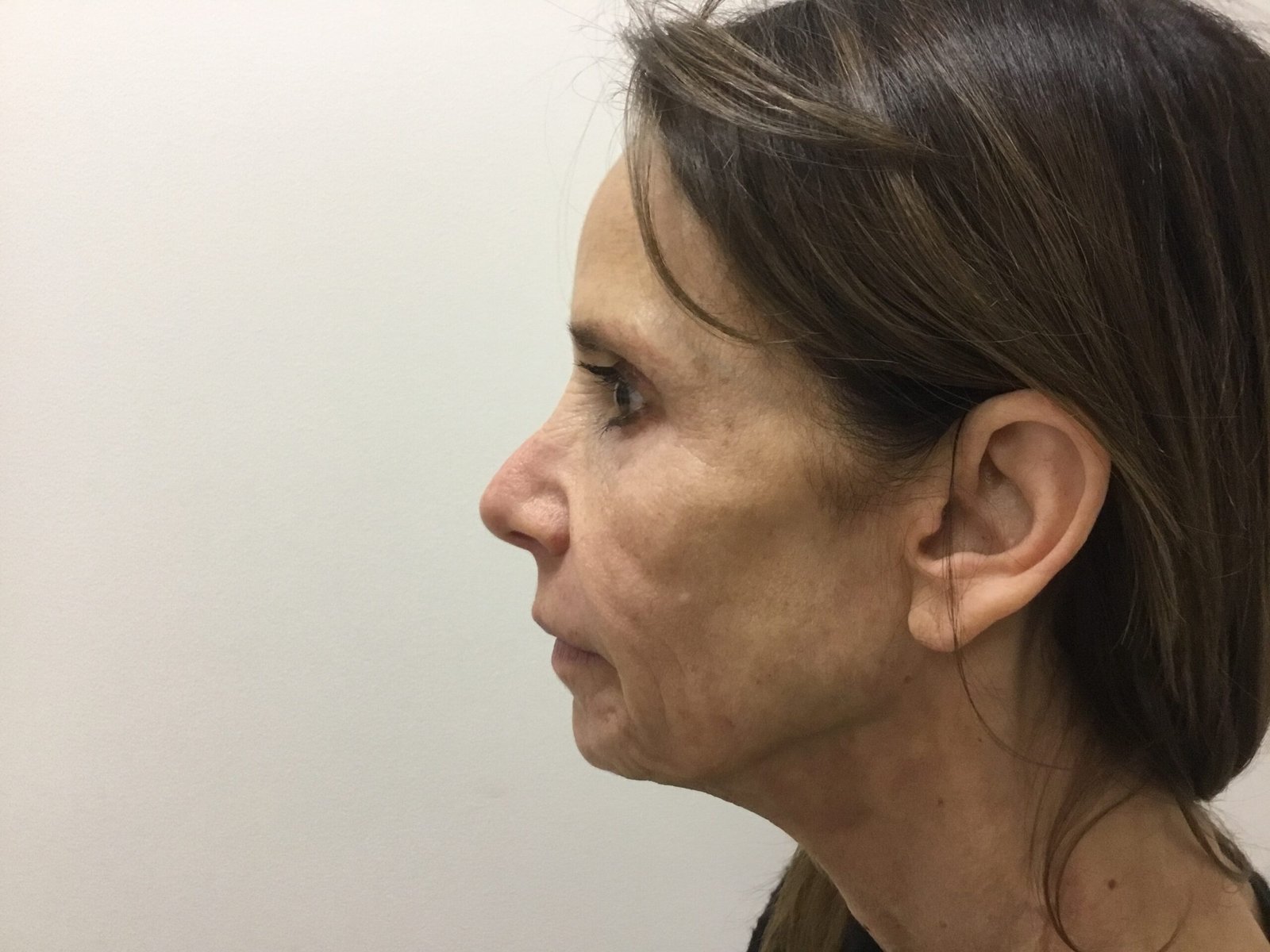 Cheek Filler before and after - before