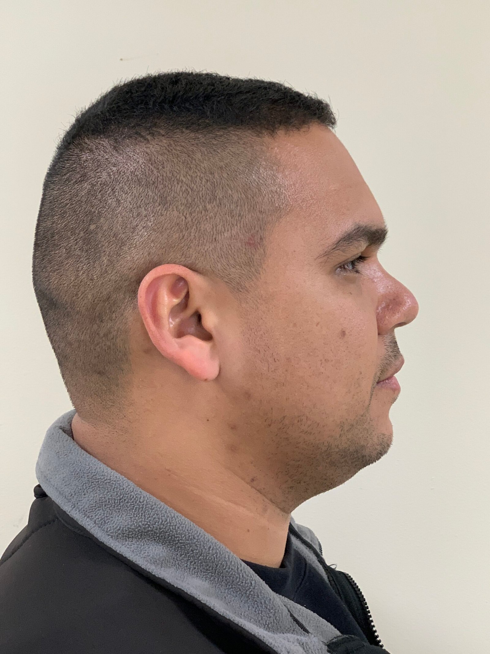 Rhinoplasty before and after - after