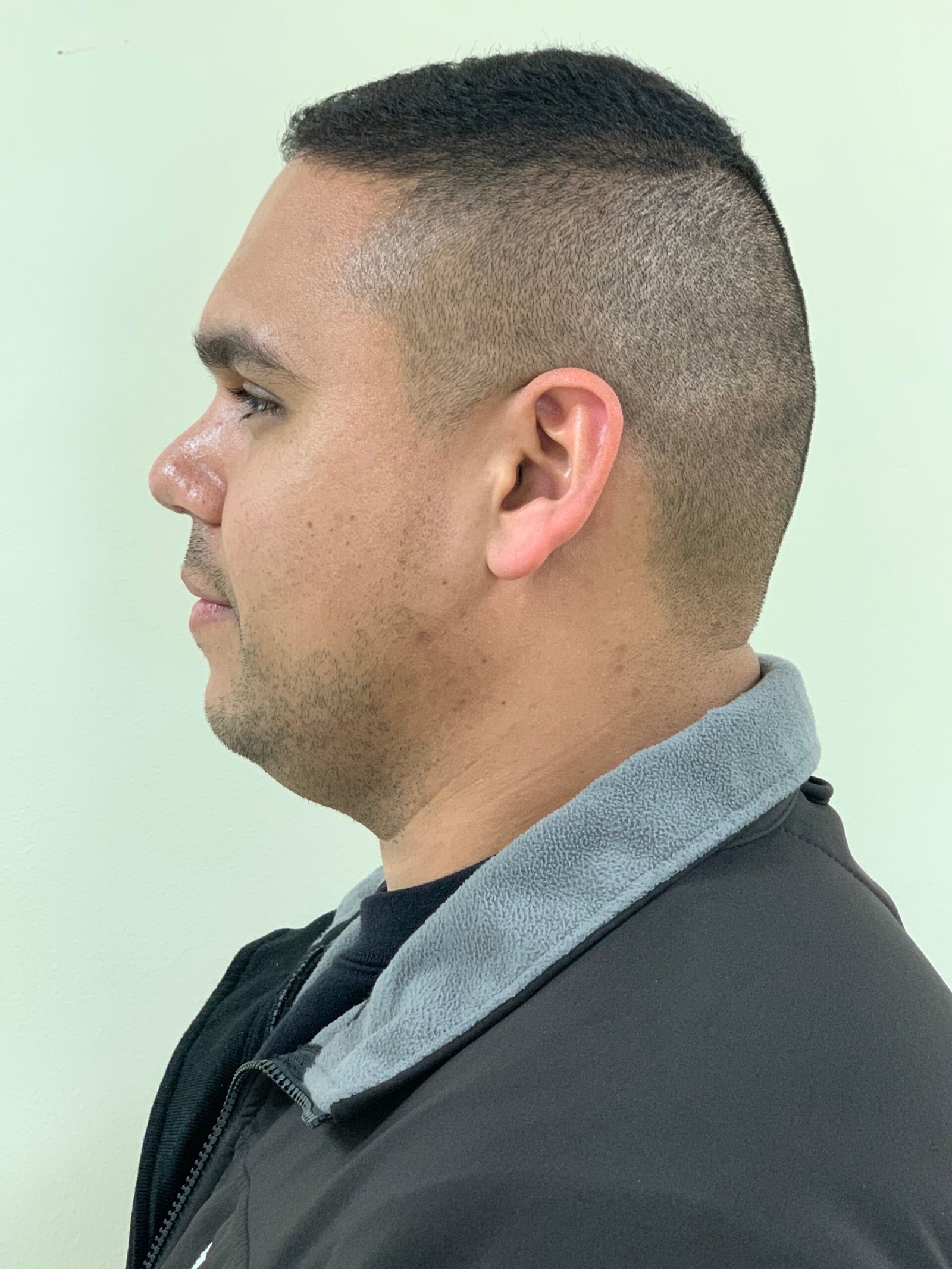 Rhinoplasty before and after - after