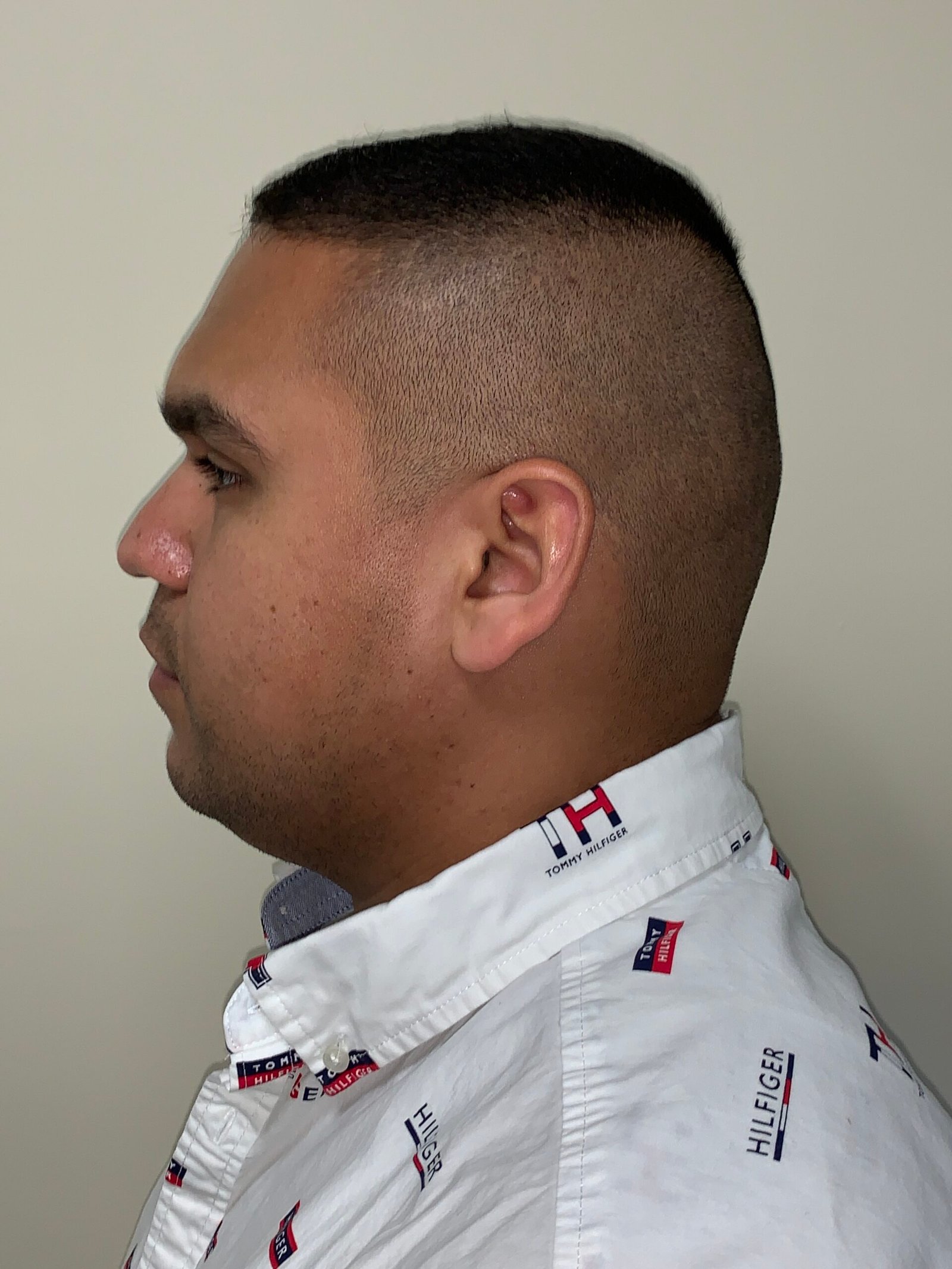 Rhinoplasty before and after - before