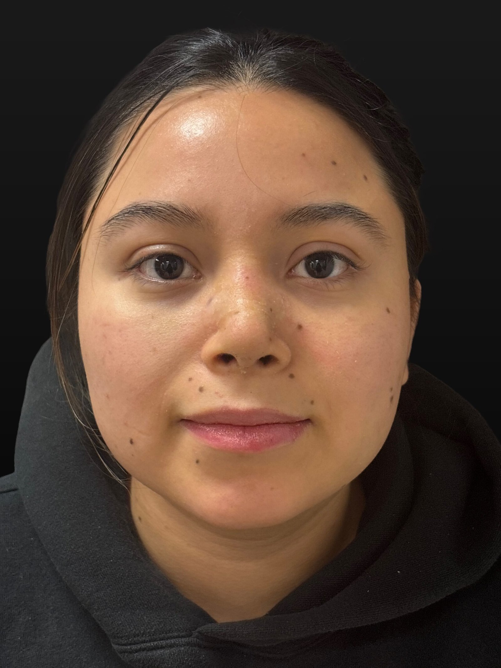Rhinoplasty before and after - after