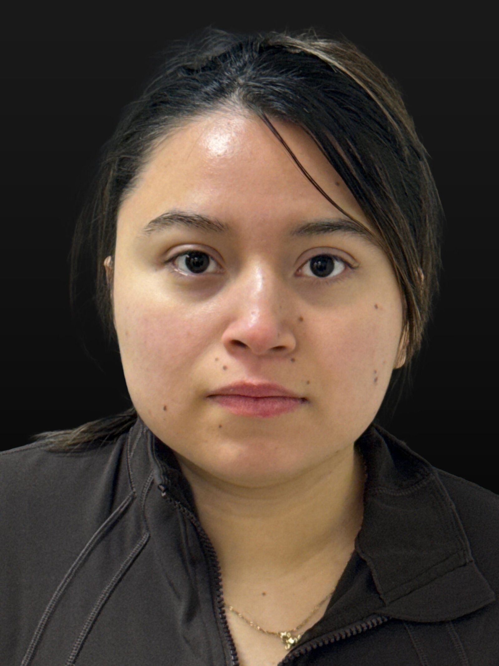 Rhinoplasty before and after - before