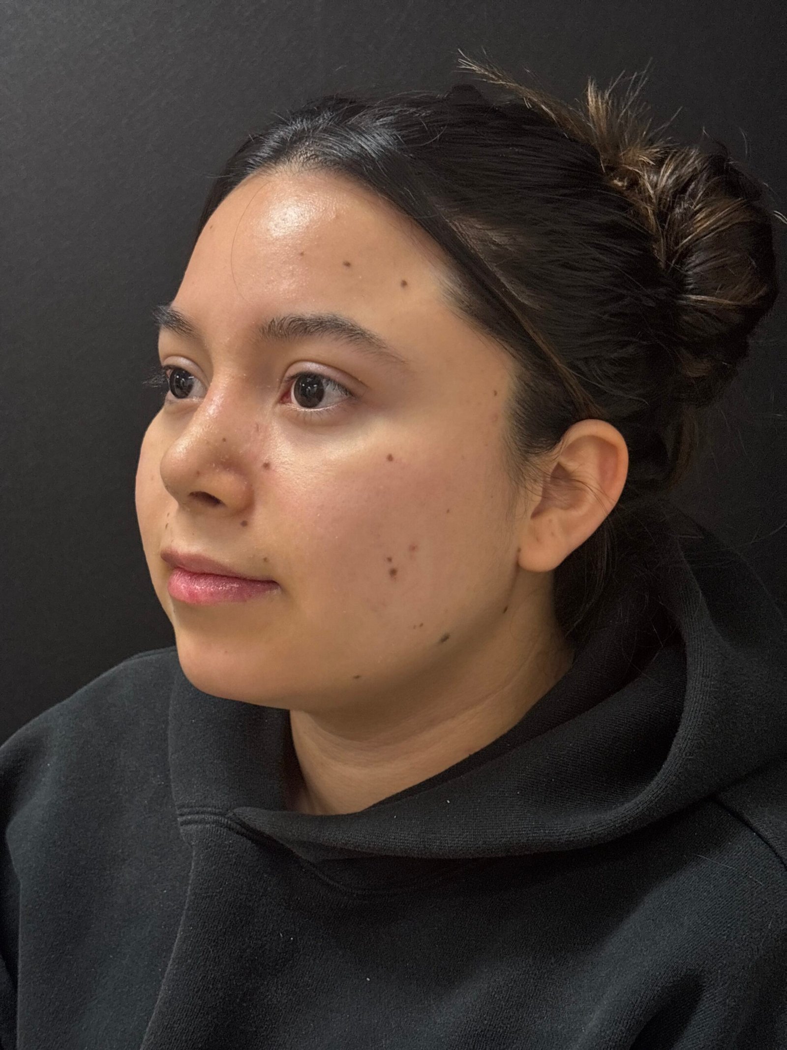 Rhinoplasty before and after - after