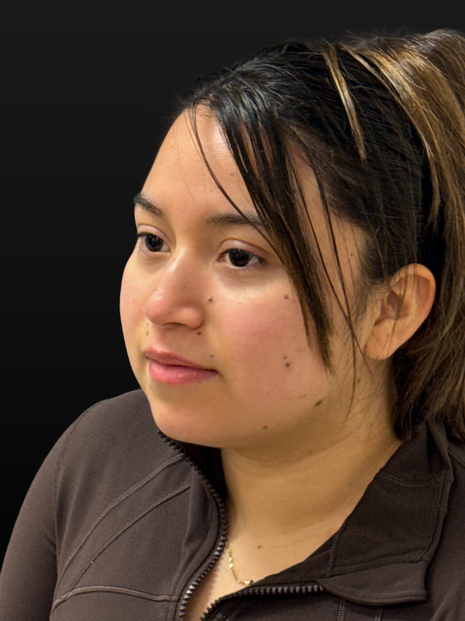 Rhinoplasty before and after - before