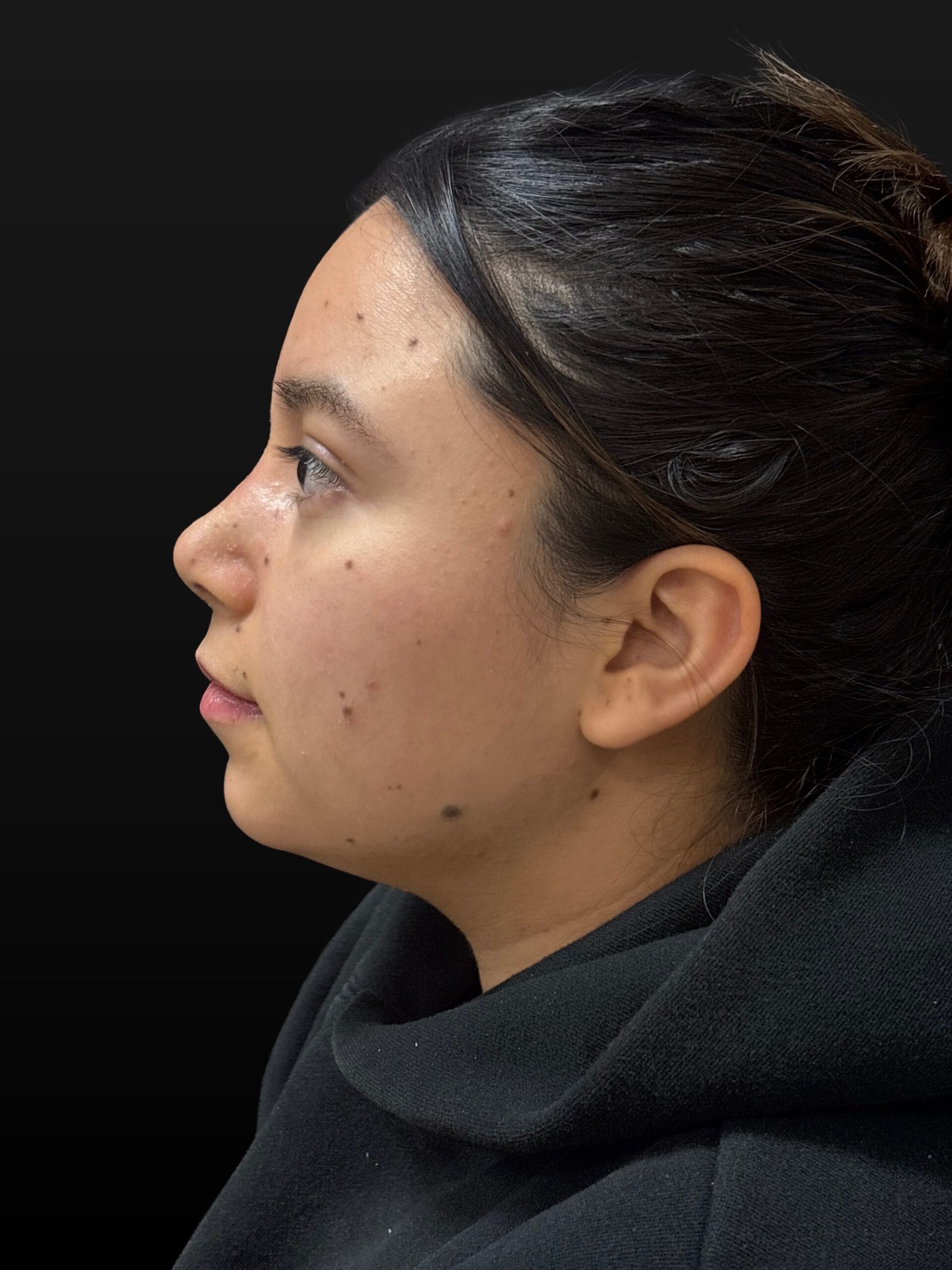 Rhinoplasty before and after - after