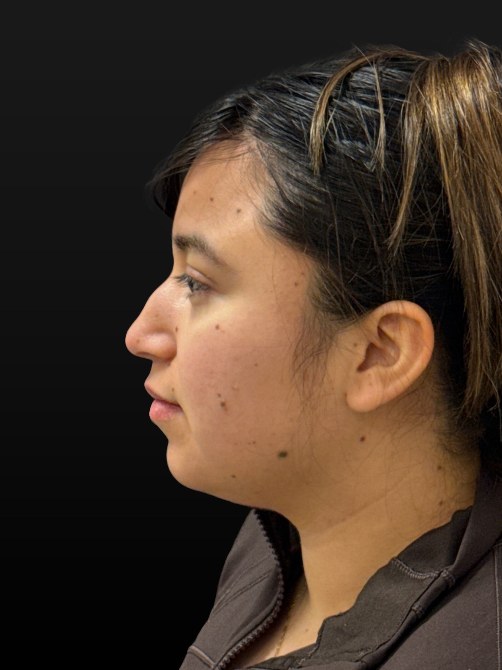 Rhinoplasty before and after - before