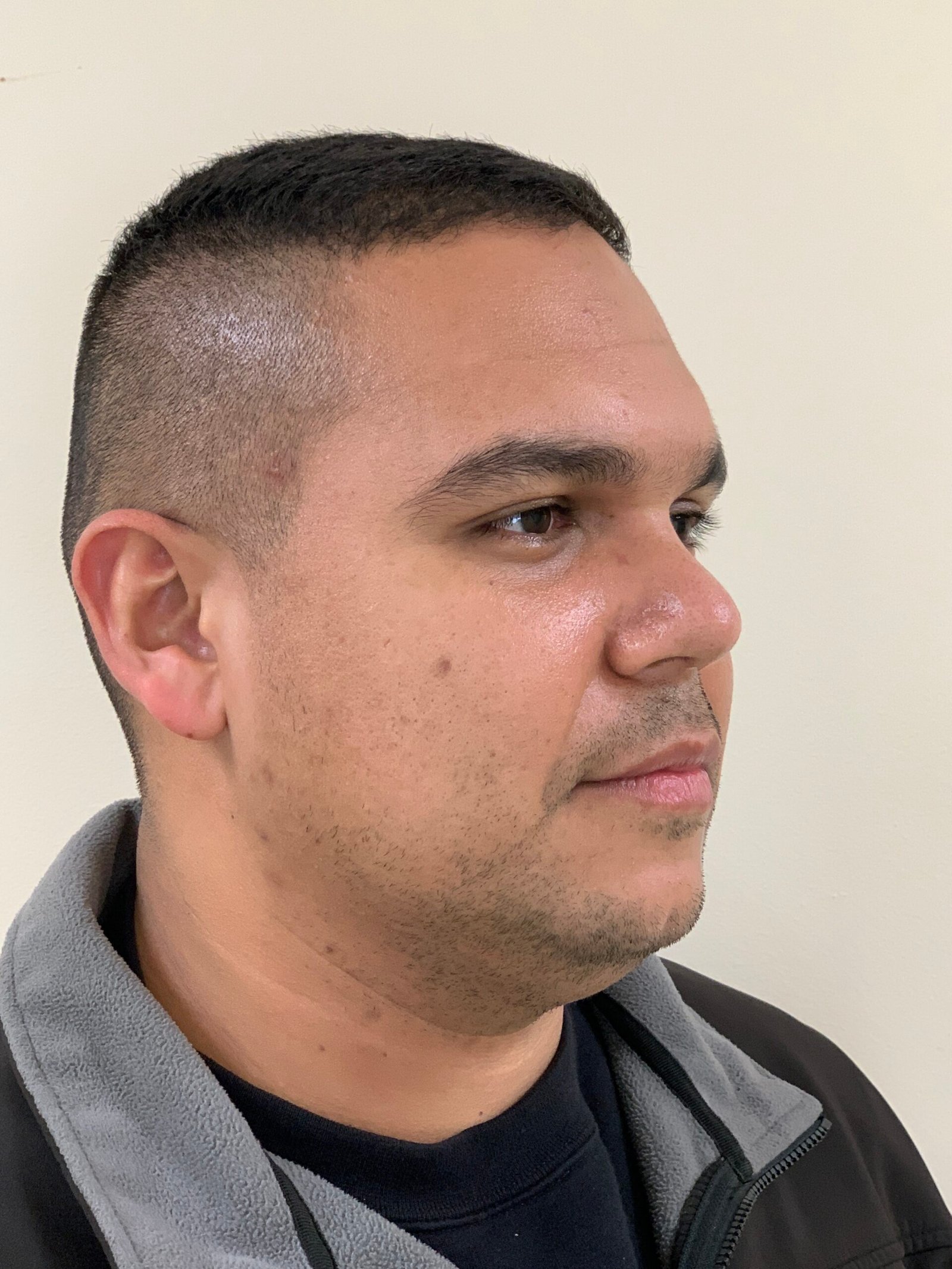 Rhinoplasty before and after - after